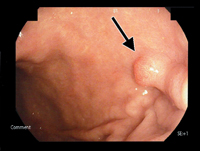 通常画像の胃ポリープの内視鏡像