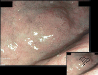 強調画像(OE)の早期胃癌の内視鏡像