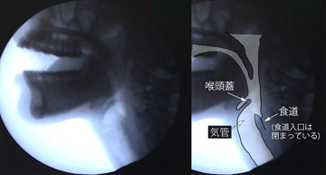 苦しくない胃カメラ検査の説明＝口腔から下咽頭のレントゲン像