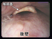 苦しくない胃カメラ検査の説明＝喉の狭いケース