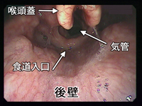 苦しくない胃カメラ検査の説明＝喉の広いケース