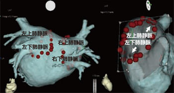 CARTOシステムを用いた肺静脈隔離の図